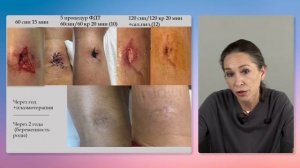 вебинар Карповой Е.Л. для врачей-партнеров REVIXAN по возможностям ФДТ в дерматологии и косметологии