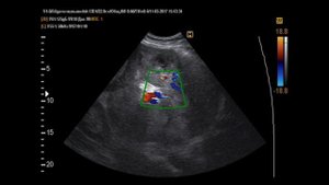 Метастазы печени на УЗИ