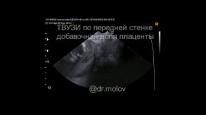 Предлежание сосудов на УЗИ