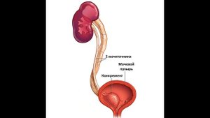 1 камень 2 мочеточника на УЗИ