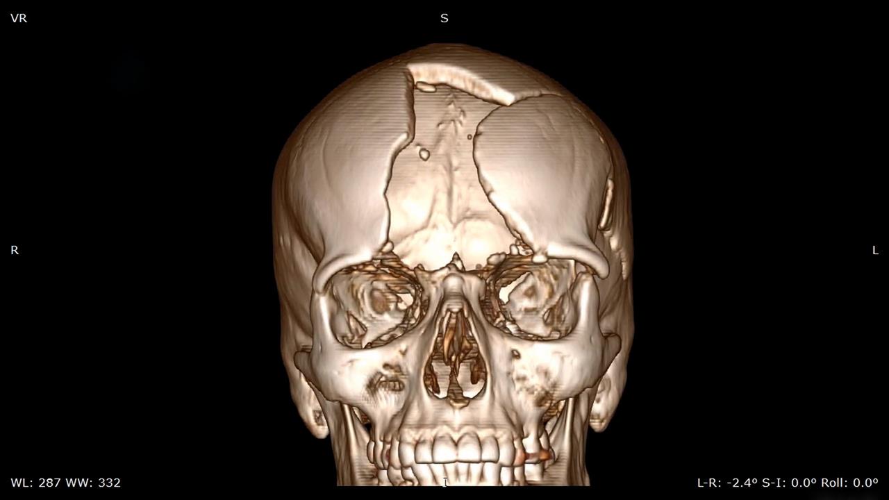 Бойца СВО с разрушением 90% лобной кости спасли врачи из Свердловской области