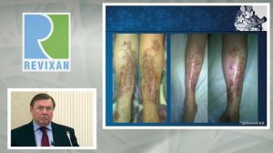 Фотодинамическая косметология. Мастер-класс: Технология REVIXAN