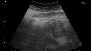 Рак желудка на УЗИ