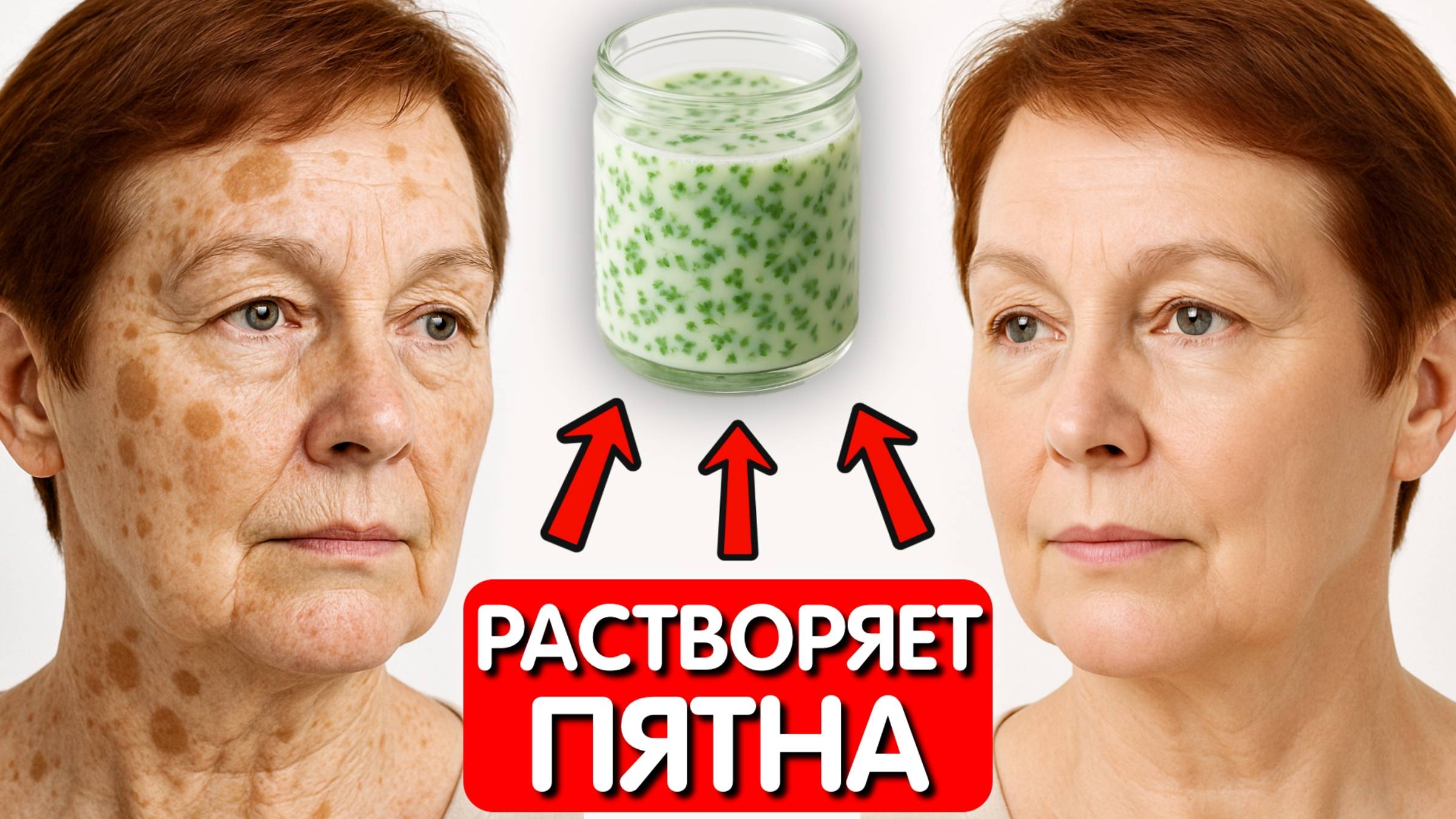 Думала, ничего не поможет...Но ЭТО МОЛОЧКО СТИРАЕТ ПИГМЕНТНЫЕ ПЯТНА КАК ЛАСТИК за 7 дней ! смотреть онлайн