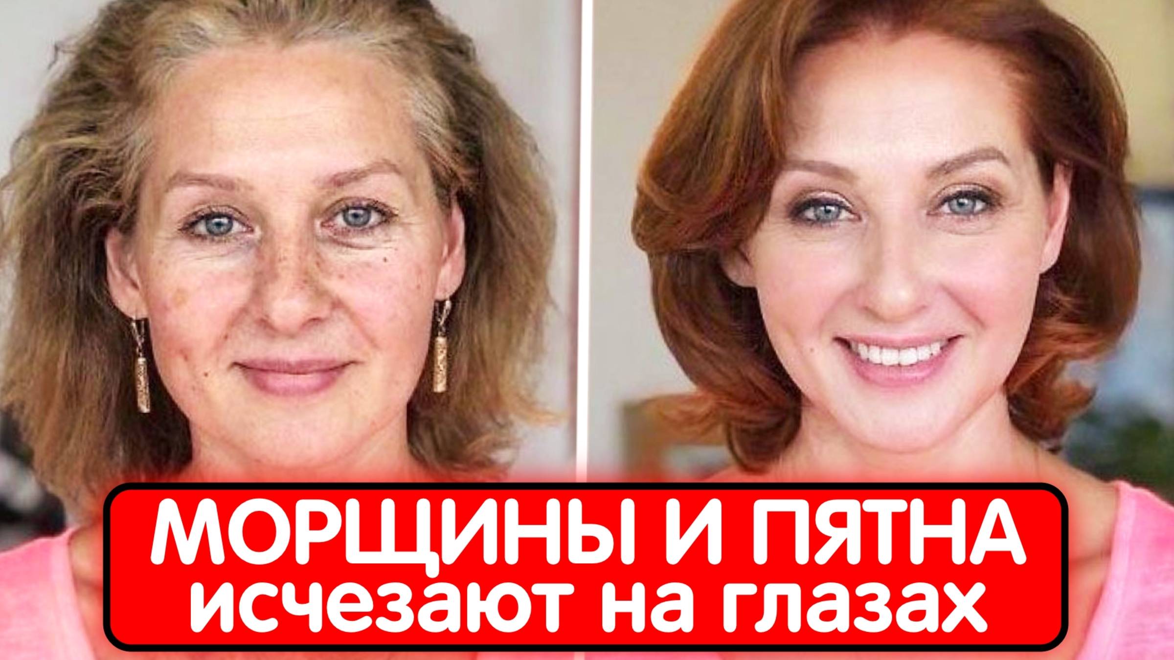 ВСЕ ДУМАЛИ ЧТО ОНА СДЕЛАЛА ПОДТЯЖКУ а Она сделала ОМОЛОЖЕНИЕ СОЛЬЮ и ЗАБЫЛА ПРО МОРЩИНЫ ! смотреть онлайн