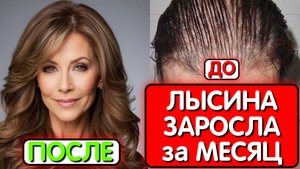 ВОЛОСЫ РАСТУТ даже на залысинах ! КАПУСТА ТВОРИТ ЧУДЕСА - Густые волосы за месяц !