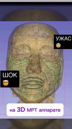Уколы в лицо🥹Филлеры и гиалуроновая кислота