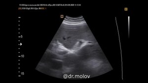 Перипортальны фиброз на УЗИ