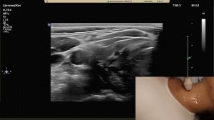 УЗИ щитовидной железы