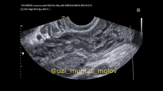Тромбоз Вен малого таза  ОМТ