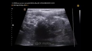 рак щитовидной железы на УЗИ