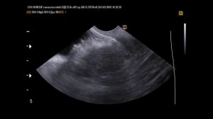 Парауретральные кисты на УЗИ 2 случая