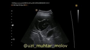 Эхинококкоз печени на УЗИ