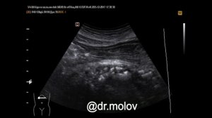 Хр. кальк. панкреатит на УЗИ