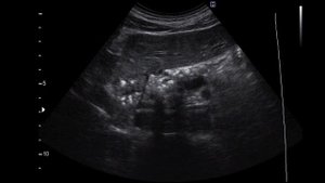 Калькулезный панкреатит на УЗИ