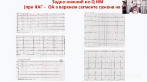 ЭКГ-признаки окклюзирующих и прогностически неблагоприятных поражений коронарных артерий