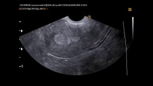 Синехии, несколько случаев на УЗИ