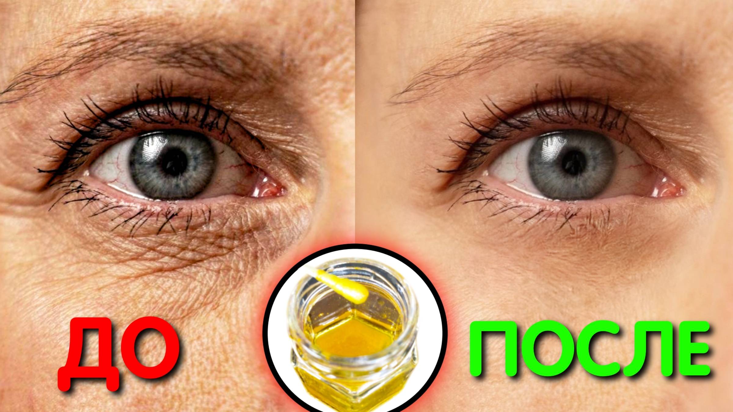 Я снова как Девочка! АПТЕЧНОЕ СРЕДСТВО СТИРАЕТ МОРЩИНЫ ВОКРУГ ГЛАЗ за ночь даже в 70 лет! смотреть онлайн