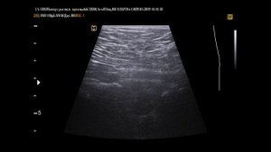 Симфизит на УЗИ