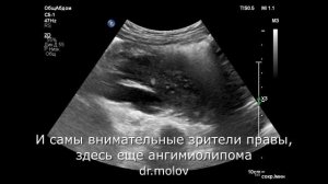 Дистопия почки  2