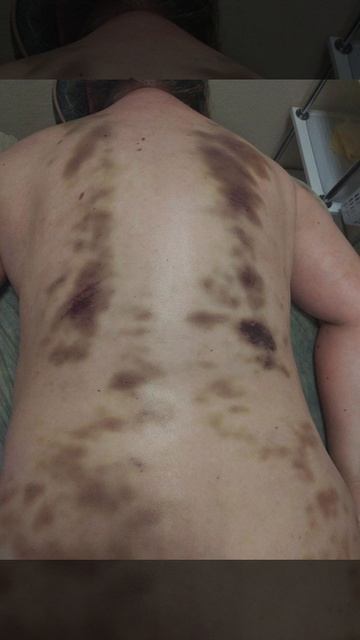 Синяки-спайки