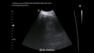 Гематома печени на УЗИ