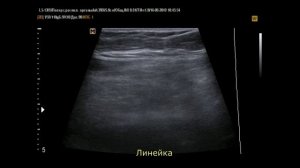 О аппендицит на УЗИ ( 1)