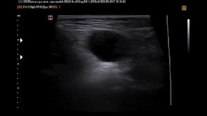 Фуникулоцеле