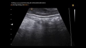 Образование поджелудочной железы на УЗИ