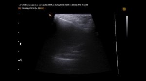 Гайморит на УЗИ Пазух