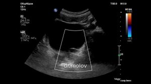 Уретероцеле на УЗИ