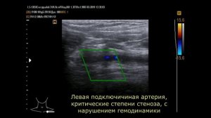 Такаясу болезнь на УЗИ