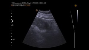 Стент почечно мочеточниковый на  УЗИ