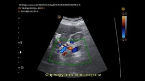 Осложнение цирроза печени на УЗИ