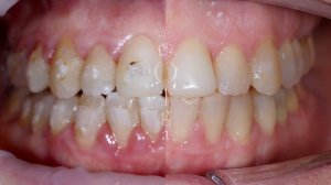 Кровоточивость дёсен после брекетов: результат лечения