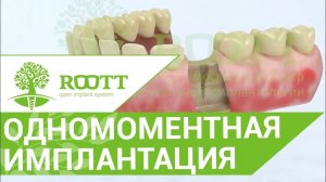 Имплантация после удаления.  Одномоментная имплантация сразу  после удаления зуба/