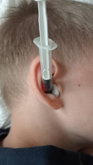 Пиявка в ухе, постановка пиявки на нижнюю ушную ямку в лечебных целях