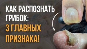 3 главных признака грибка!