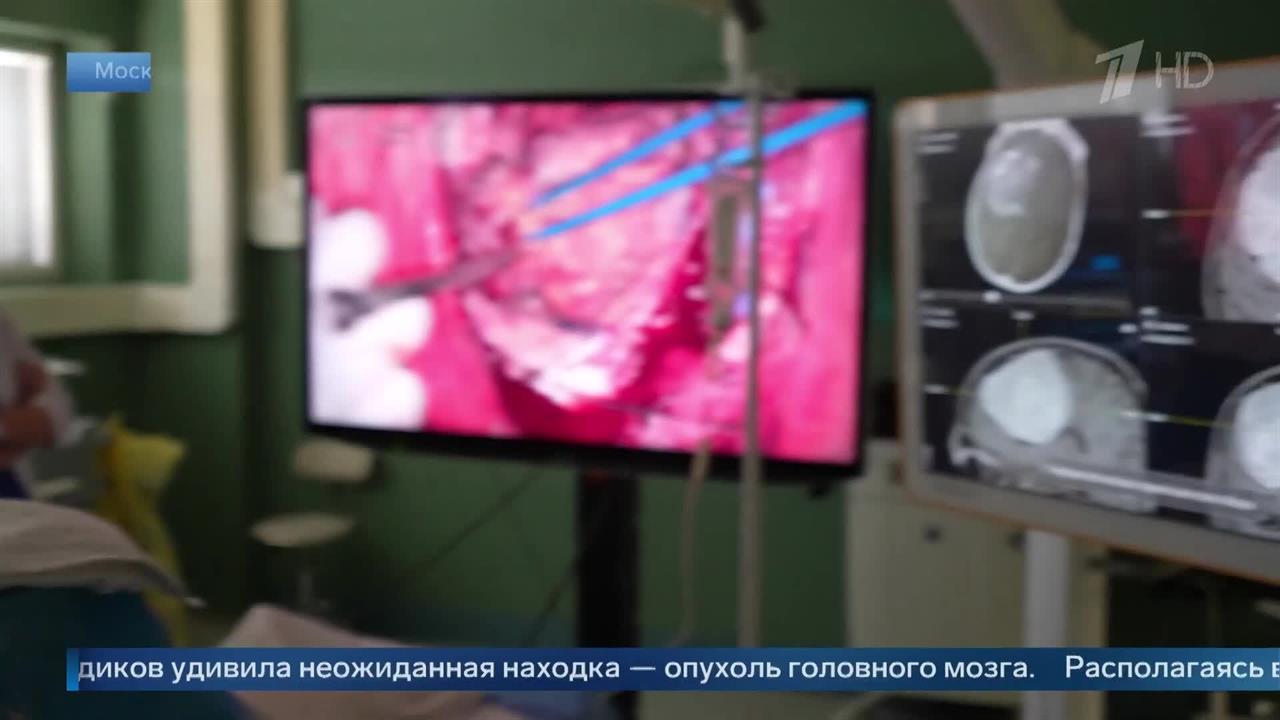 "7,5 см в длину" - хирург об удаленной у пациента с помощью экзоскопа опухоли мозга