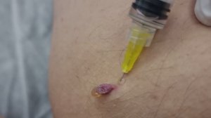 Удаление папилломы в клинике Чудо Доктор
