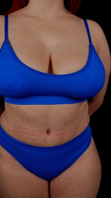 Липоабдоминопластика - результат преображения спустя 3 месяца после операции