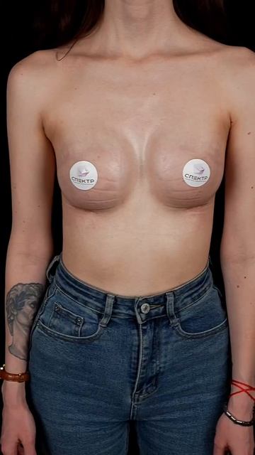 Увеличение груди имплантами - результат спустя месяц