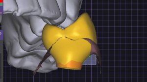 Правила отдавливания десны в ортопедических конструкциях.