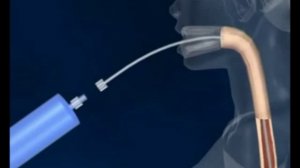 Внутрижелудочный баллон