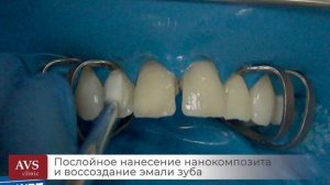 📽️ Посмотрите, как происходит эстетическая реставрация зубов!