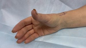 Перед операцией ограничение подвижности 1 пальца