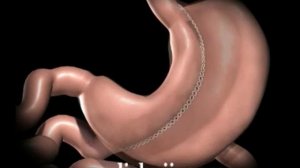 Продольная резекция желудка (СЛИВ)