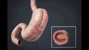 Гастропликация (СЛИВ 2)