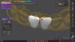 Постановка зубов в динамической окклюзии