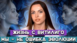 Жизнь с витилиго. Как блогер превратила свою болезнь в успешное дело